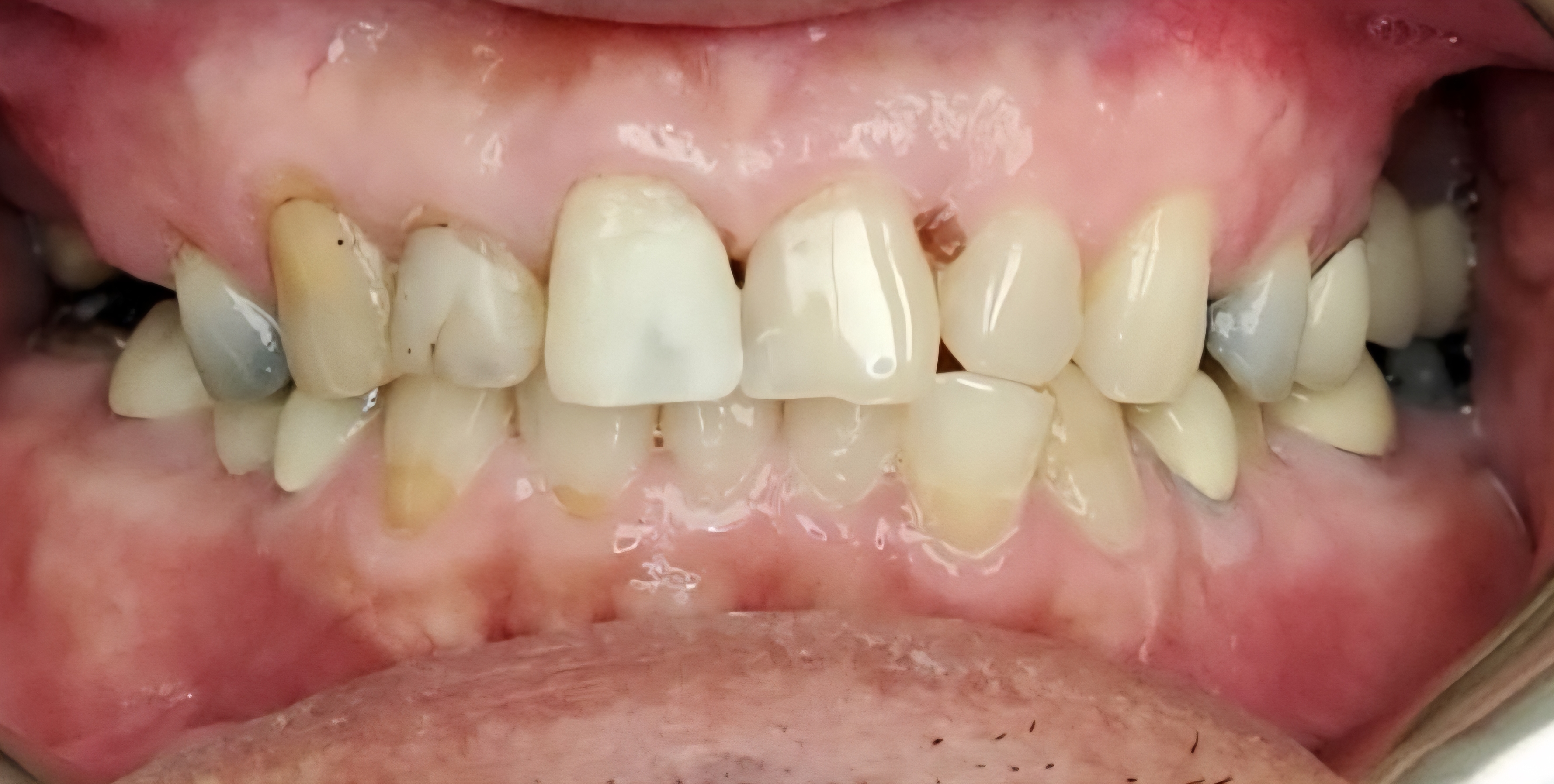 Cosmetic dentistry before treatment at Elm Ridge Implant and Family Dentistry in Killeen, TX
